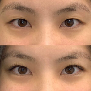 Eyewonderlust Eyelash Extensions for Asian Monolids Eyes Before and After Cosmetic Treatment and Correction Comparison Closeup